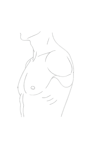 Gynecomastia Surgery